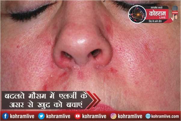 # Allergy : बदलते मौसम के असर से खुद को बचाएं # Allergy : बदलते मौसम के असर से खुद को बचाएं