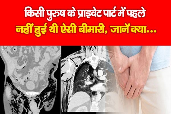 किसी पुरुष के प्राइवेट पार्ट में पहले नहीं हुई थी ऐसी बीमारी, जानें क्या... किसी पुरुष के प्राइवेट पार्ट में पहले नहीं हुई थी ऐसी बीमारी, जानें क्या...