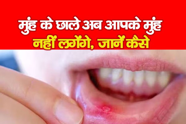 मुंह के छाले अब आपके मुंह नहीं लगेंगे, जानें कैसे मुंह के छाले अब आपके मुंह नहीं लगेंगे, जानें कैसे