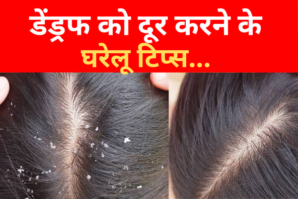 डेंड्रफ को दूर करने के घरेलू टिप्स... डेंड्रफ को दूर करने के घरेलू टिप्स...